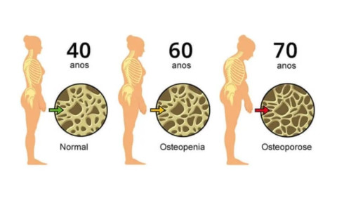 Osteoporose: a doença silenciosa