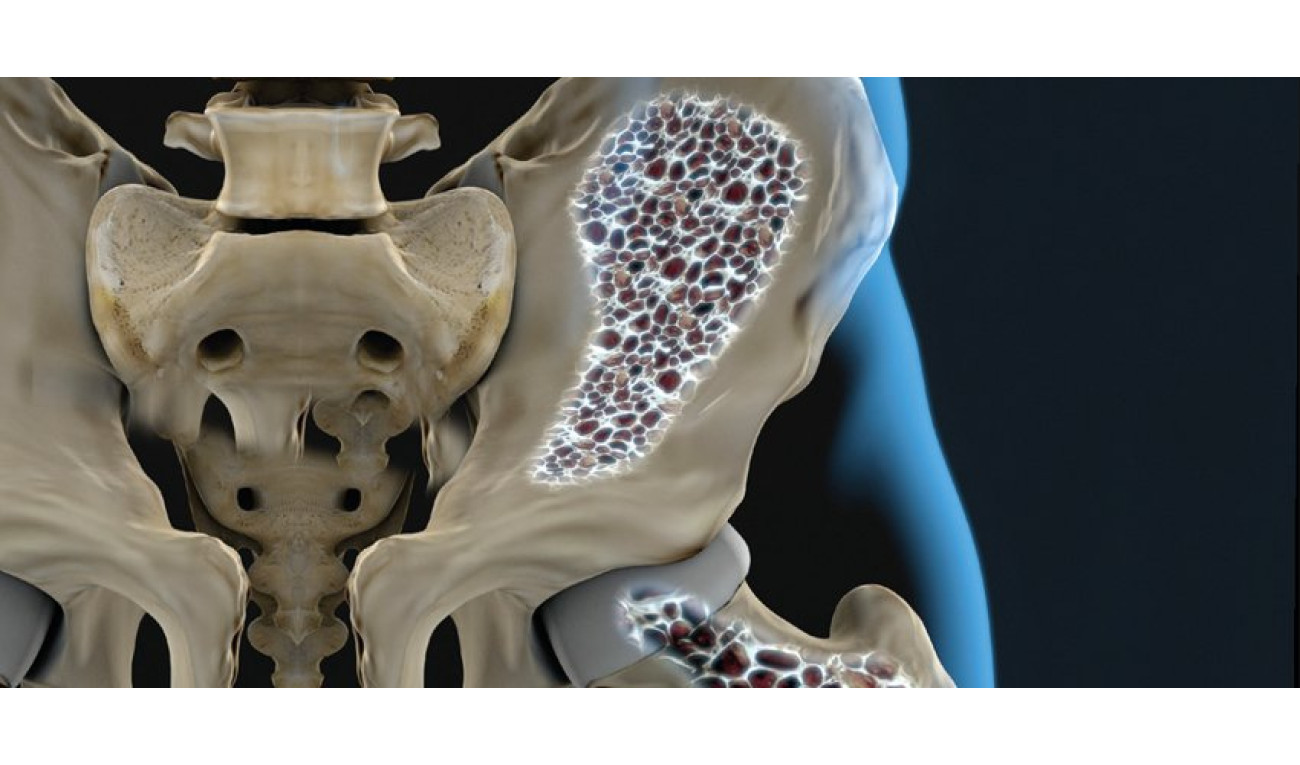Como identificar e prevenir a osteoporose?